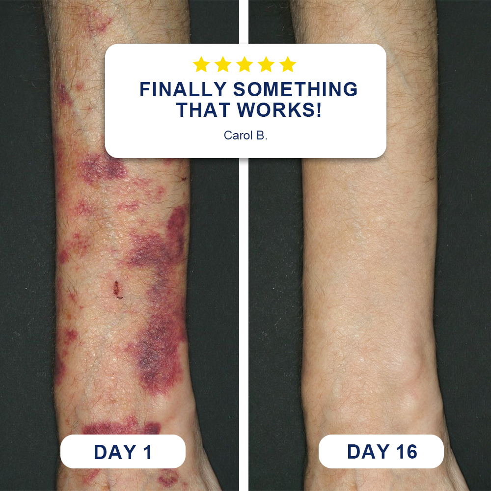 ✨Evolvion® Bruise Repair & Skin-Strengthening Cream 🌼-🌼-🌼