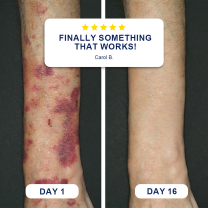 ✨Evolvion® Bruise Repair & Skin-Strengthening Cream 🌼-🌼-🌼